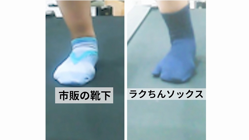 症例103│スポーツソックスとラクちんソックスによる舟状骨の位置比較（動画あり）