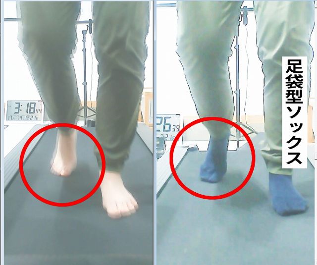 素足と足袋型ソックスで歩行を比較。足袋型ソックスでは、蹴り出す前の段階で親指の外反が確認された。