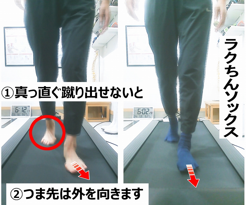足底腱膜炎の原因と治し方