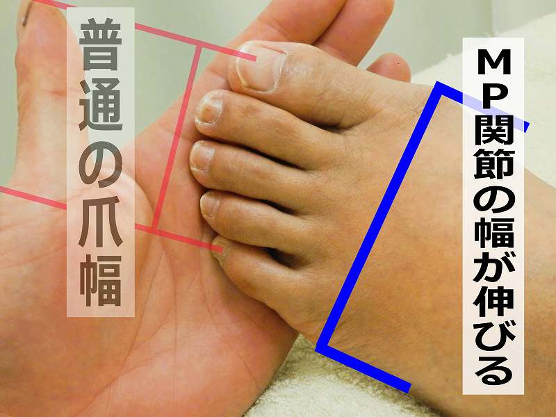 外反母趾の説明