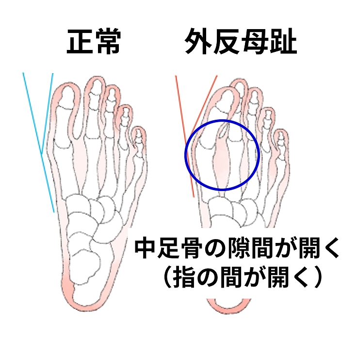 外反母趾に五本指ソックスは効果がある?