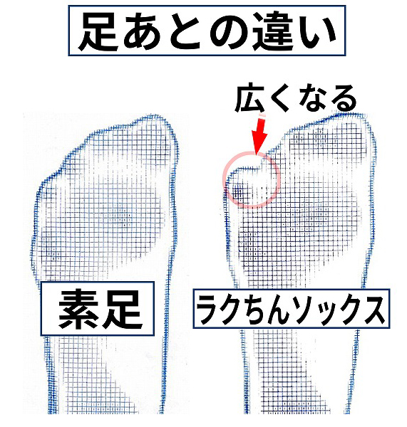 寝指・内反小趾の改善