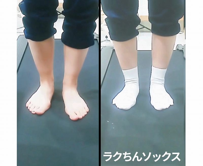 アーチの低下はなぜ起きるか？説明