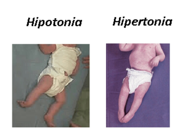 Que es una hipertonia muscular