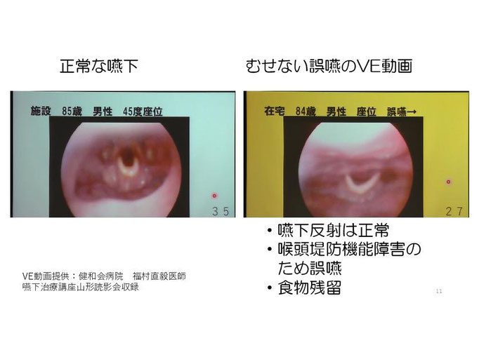 正常な嚥下VE動画、むせずに誤嚥しているVE動画