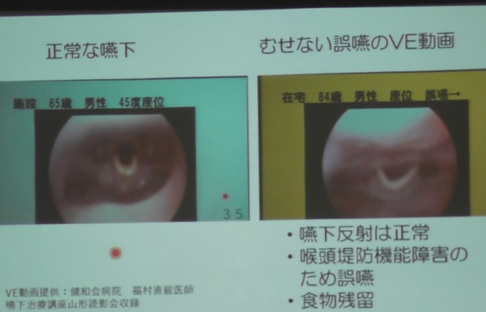 正常な嚥下とむせない誤嚥の内視鏡動画