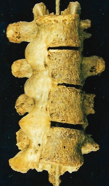 Vertebral column with diffuse idiopathic skeletal hyperostosis
