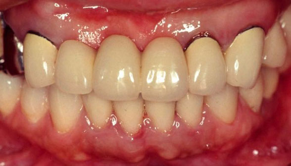 犬歯〜犬歯までの6本のメタルセラミックスブリッジが口腔内に入っています。このセラミックスのブリッジは上記の天然の歯に比べ単調な色調で、暗い（黒ずんで見える）