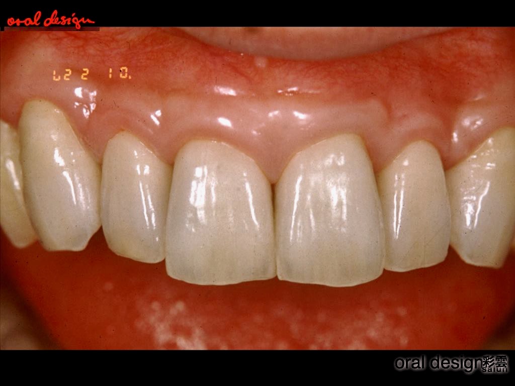 口元が綺麗に見えるよう歯牙を並べ製作した連結メタルセラミックスクラウン。 下部固形空隙（歯と歯の間の隙間は）無くなり、自然観が回復された口腔内。
