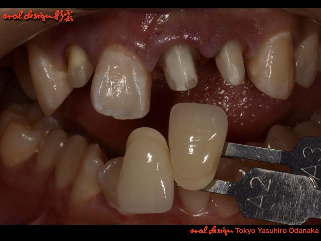 右側中切歯はレジン充填にて修復し、３前歯が形成された状態。シェードテイキング。