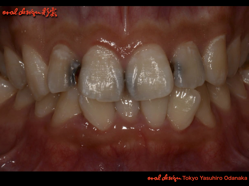 主訴：前歯部のカリエス（虫歯）による審美障害.            