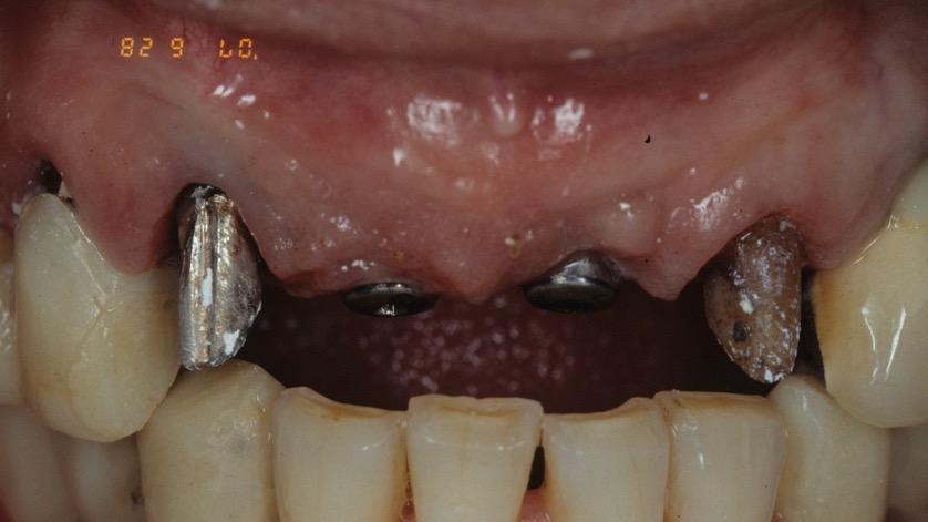 前歯部にインプラントを埋没された口腔内。