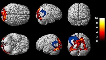 imágenes de resonancia magnética del cerebro