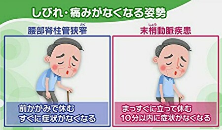 間欠性跛行の違いの図