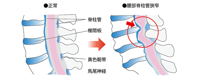 腰部脊柱管狭窄症のイラスト