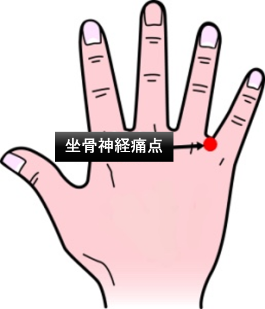 坐骨神経痛点図