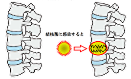 脊椎カリエス絵図