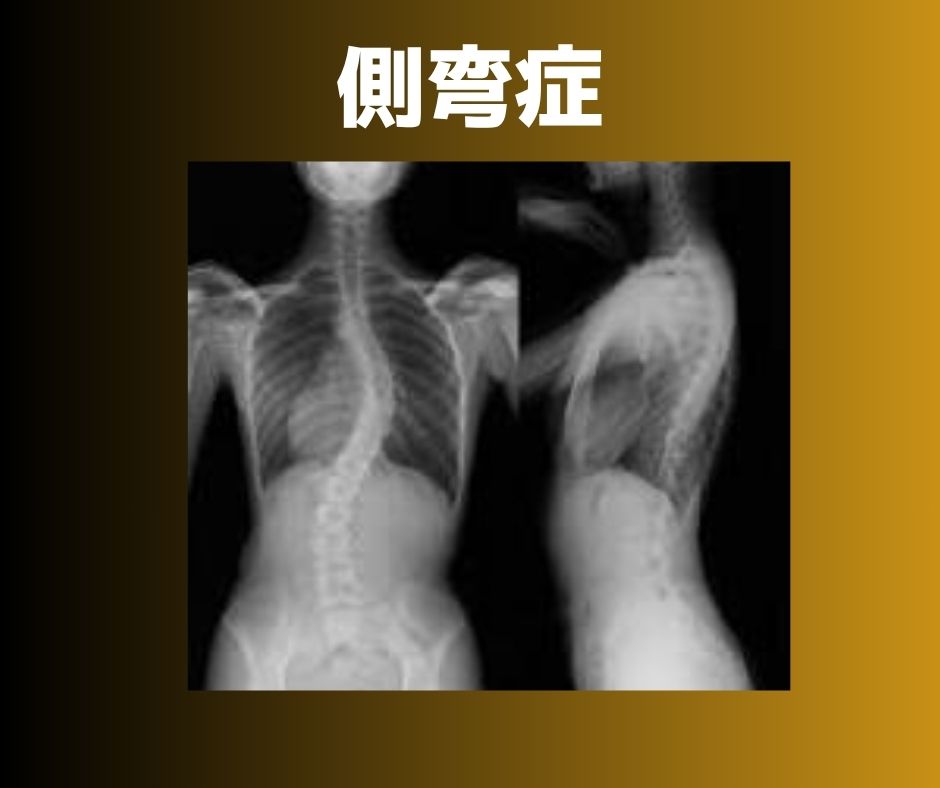 側弯症