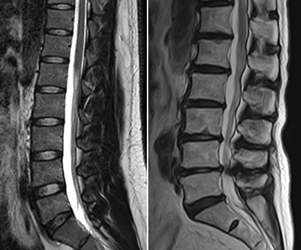 腰部脊柱管狭窄症のMRI画像