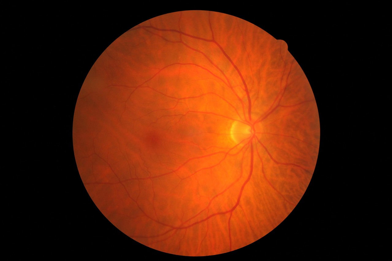 Digitale Fotodokumentation - der Netzhaut - Augenärzte Papst Hamburg