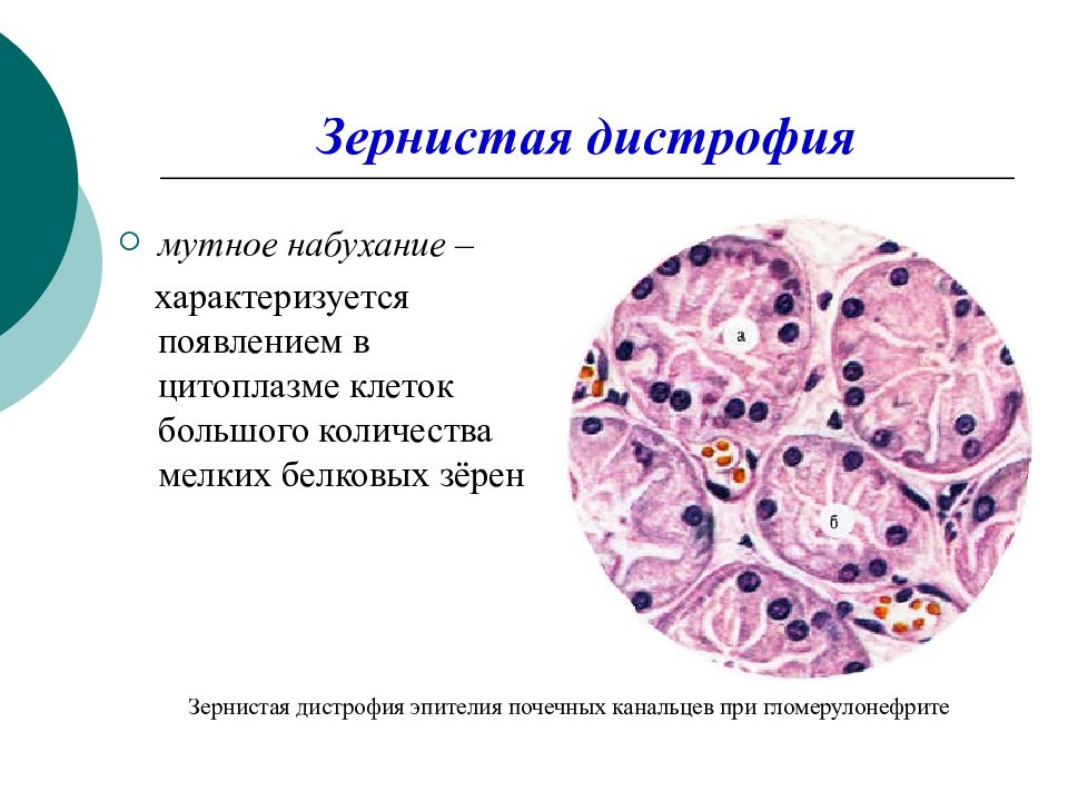 Дегенерация клеток. Микроскопические изменения зернистая дистрофия. Зернистая дистрофия эпителия канальцев почки макропрепарат. Зернистая белковая дистрофия микроскопия. Зернистая дистрофия микроскопия.