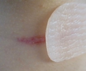 Gastblog von Viviane Gut: Silikon in der Wundheilung. Teil 1