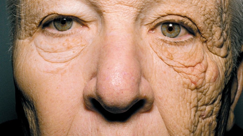 Warum ist die Sonnenstrahlung gefährlich für unsere Haut?