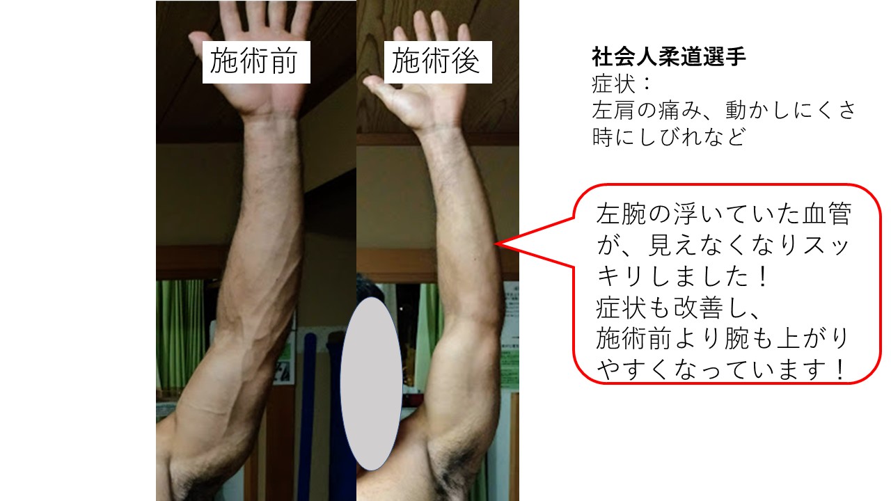 胸郭出口症候群 Tos 疑いの柔道選手 岐阜市で整体なら 日本代表サポート経験の確かな技術 みなみ鍼灸接骨院 胸郭出口症候群 Tos 疑いの柔道選手 岐阜市で整体なら 日本代表サポート経験の確かな技術 みなみ鍼灸接骨院