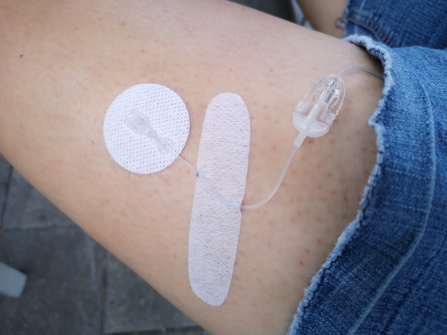 Um die Pumpe mit dem Körper zu "verbinden", benötigt man Katheder. Diese gibt es aus Teflon und aus Stahl - in verschiedenen Längen. Am Bein trage mittlerweile gerne Stahlkatheder in 6 mm Länge! Am Bauch nutze ich lieber Teflon.