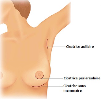 Prothèse mammaire - Chirurgie plastique et esthétique Dr Vivien MORIS