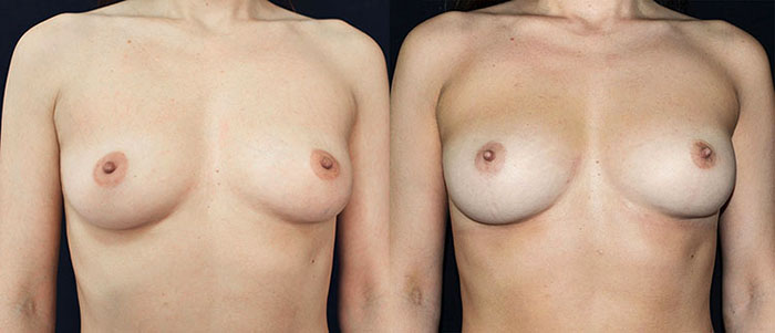 Augmentation mammaire par lipofilling 