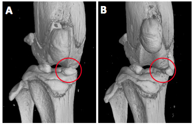 Induction of murine osteoarthritis by destabilization of the medial meniscus (DMM).