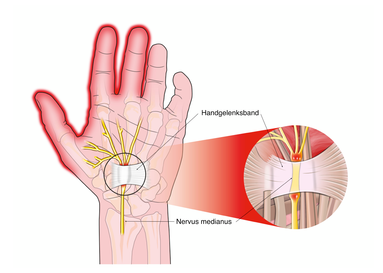 Karpaltunnelsyndrom Cts Orthohandpraxis