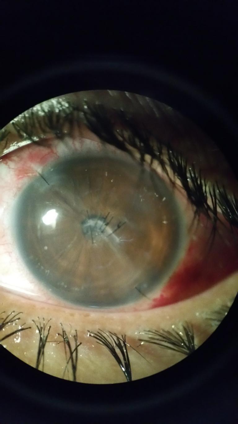 The corneal wound is sewn. Werner replaced the turbid lens with a clear plastic lens.