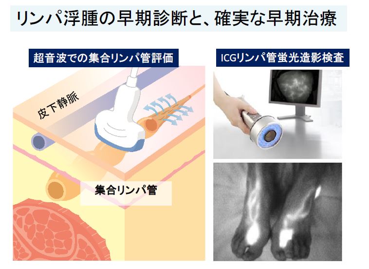 リンパ浮腫　日帰りLVA手術　保存療法　三原誠　蜂窩織炎　手術　治療　名医　その7リンパ浮腫