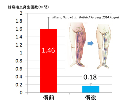 リンパ浮腫　蜂窩織炎　予防　治療　三原誠　日帰りLVA手術　LVA