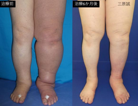在庫処分セール テ リンパ浮腫治療の症例紹介 リンパ浮腫治療の専門医療機関 - その他