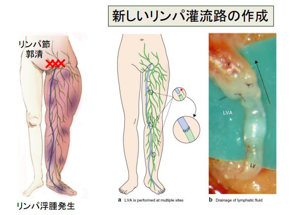 リンパ浮腫　日帰りLVA手術　保存療法　三原誠　蜂窩織炎　手術　治療　名医　その11