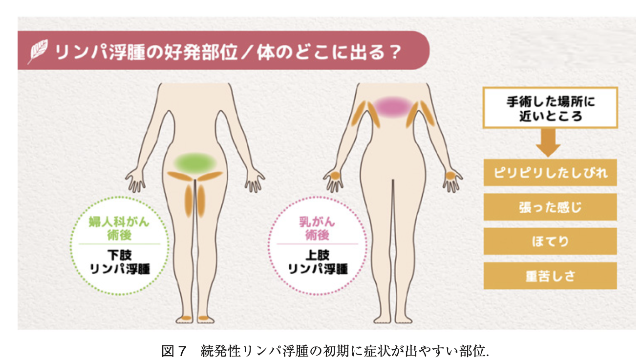 センチネルリンパ節生検後の早期リンパ浮腫(むくみクリニック 三原誠)