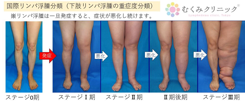 むくみクリニックの最新リンパ浮腫治療 - リンパ浮腫治療の専門