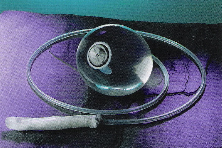 желудочный баллон для похудения. баллон для похудения. баллон для похудения. внутрижелудочного баллона. внутрижелудочный баллон медсил.