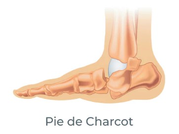 Neuroatropatía de charcot