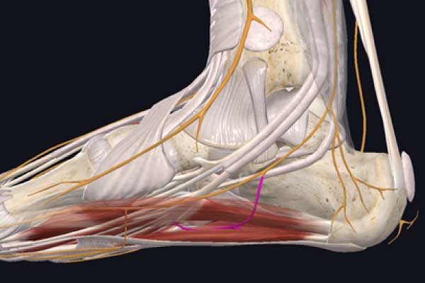 Neuropatía de baxter