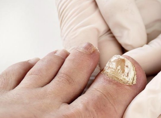 Hongos en las uñas en Lepe: cómo eliminarlos y prevenirlos