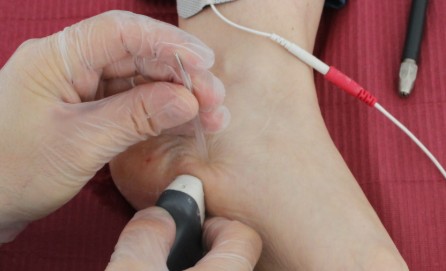 Electrólisis percutánea en fascitis plantar