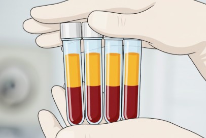 Plasma rico en plaquetas en podología: regeneración natural para el dolor del pie