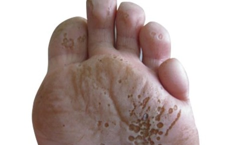 Queratólisis punctata en los pies: causas, síntomas y tratamiento en Lepe