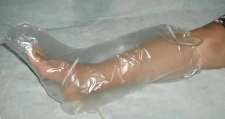 El uso del ozono en la cicatrización de úlceras: una alternativa innovadora