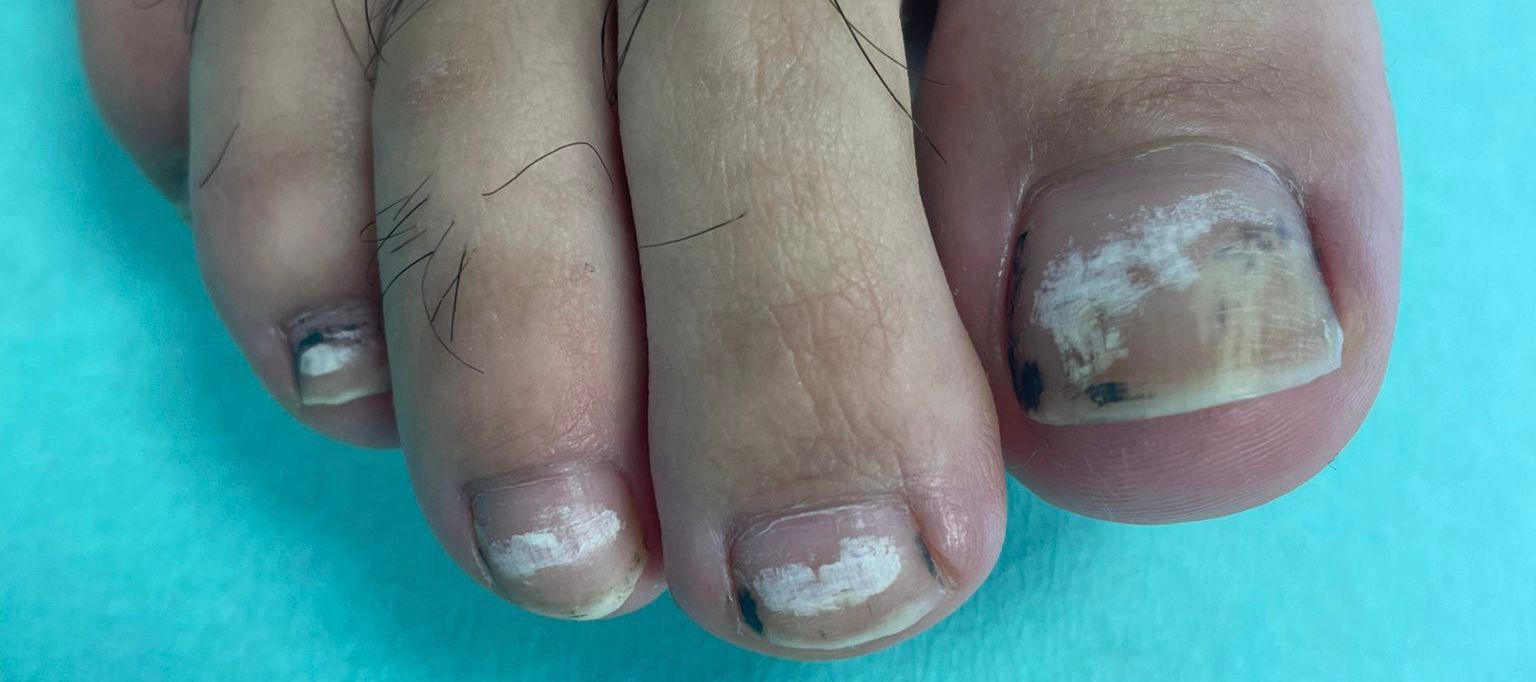 Onicomicosis y esmaltes de uñas: lo que debes saber