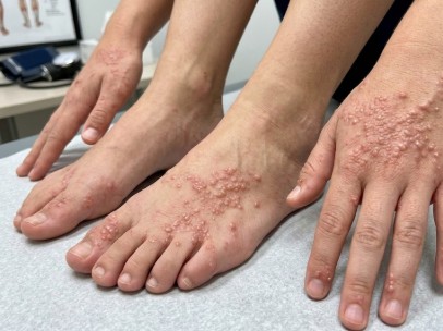 Eccema dishidrótico en los pies: síntomas, causas y tratamiento en Lepe